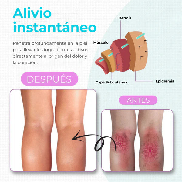 Crema Varicose Veins - Tratamiento de varices y arañitas, Resultados en 2 semanas