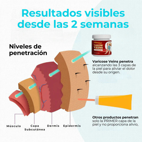 Crema Varicose Veins - Tratamiento de varices y arañitas, Resultados en 2 semanas