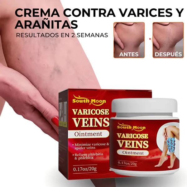 Crema Varicose Veins - Tratamiento de varices y arañitas, Resultados en 2 semanas