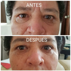 Botox Stock Solution Suero Antiarrugas